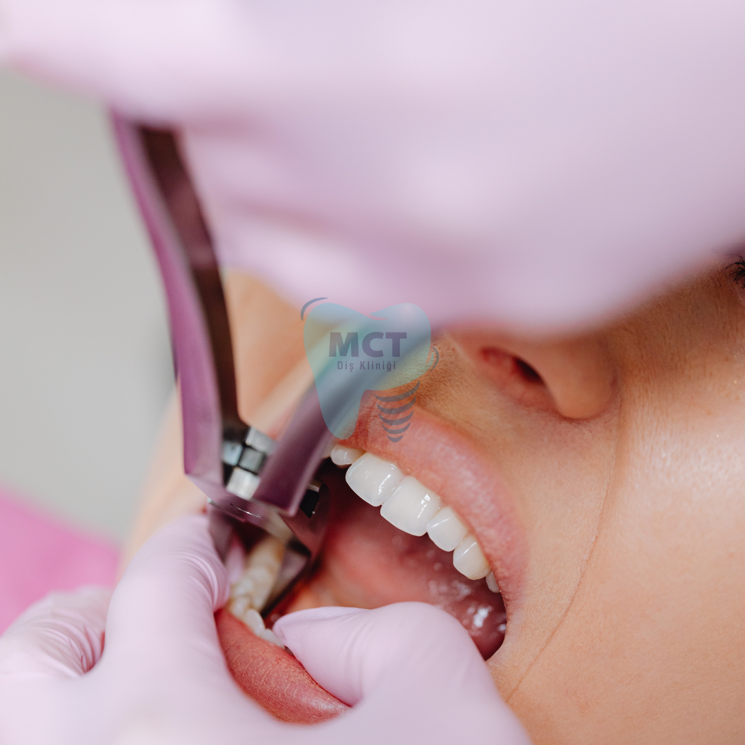 MCT-agiz-dis-istanbul-bagcilar-gunesli-gungoren-mahmutbey-yenibosna-zeytinburnu-Avcilar-Esenler-Mecidiyrkoy-bahcelievler-silirnevler-d,s-poliklinigi-implant-kanal-tedavisi-cekim-kucuk-cekmeke-buyuk-cekmece-esenyurt-esenkent-besiktas-nöbetçi dişçi -acil dişçi -bağcılar acil diş -güneşli acil diş -implant fiyat al - tam ağız implant - full ağız implant - impalt fiyat nedir - yerli implant - bağcılar implant - güneşli implant